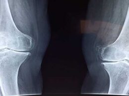 Osteoarthritis