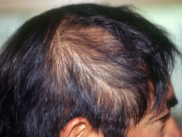 Hair Loss treatment