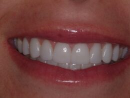 Veneers