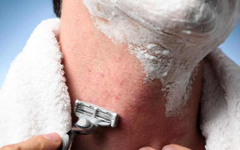 What You Need to Know About Treating Razor Bumps